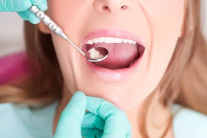 How Tooth Colored Fillings Make Your Teeth Strong Again?